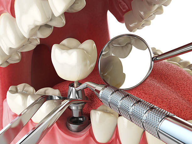 Best Emergency Tooth Extraction in Crystal City, MO
